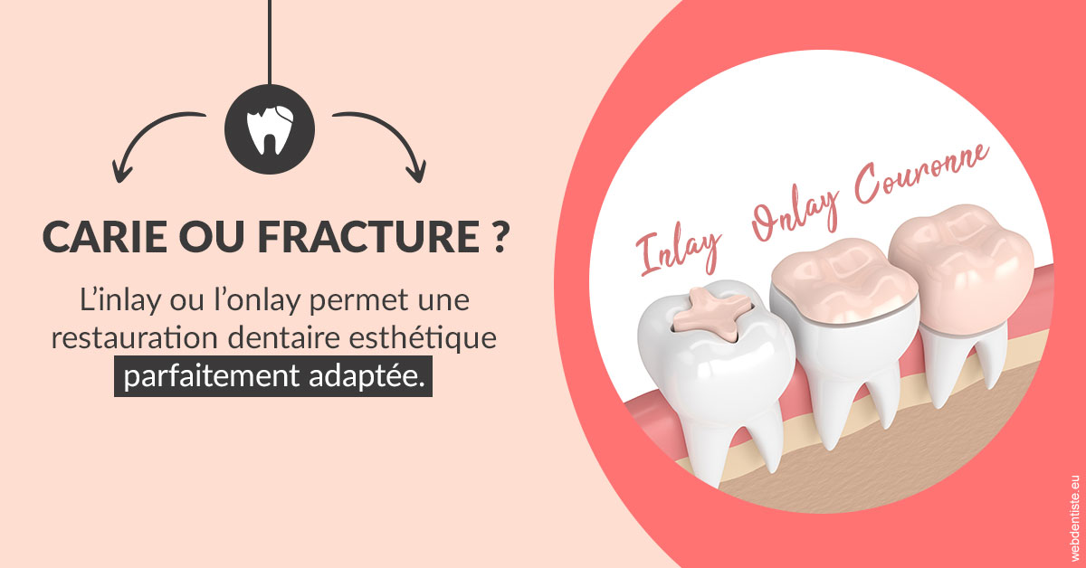 https://dr-abbou-michel.chirurgiens-dentistes.fr/T2 2023 - Carie ou fracture 2