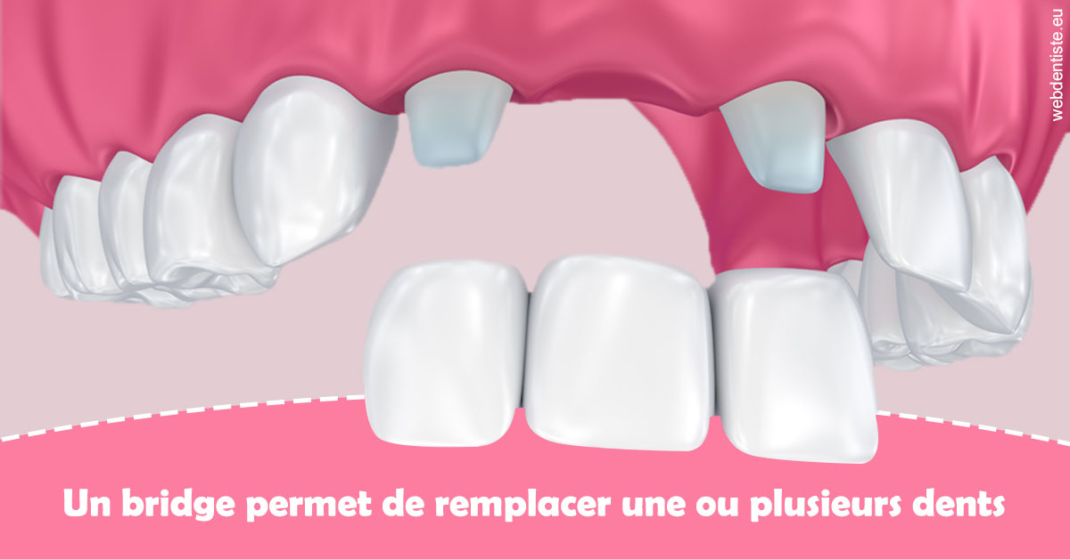 https://dr-abbou-michel.chirurgiens-dentistes.fr/Bridge remplacer dents 2