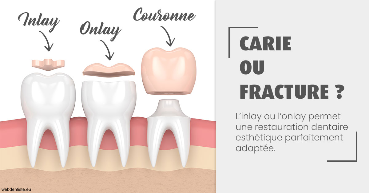 https://dr-abbou-michel.chirurgiens-dentistes.fr/T2 2023 - Carie ou fracture 1