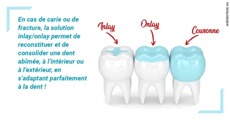 https://dr-abbou-michel.chirurgiens-dentistes.fr/L'INLAY ou l'ONLAY