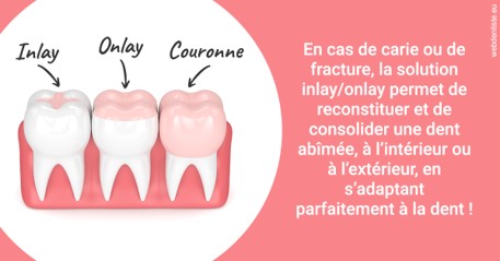 https://dr-abbou-michel.chirurgiens-dentistes.fr/L'INLAY ou l'ONLAY 2