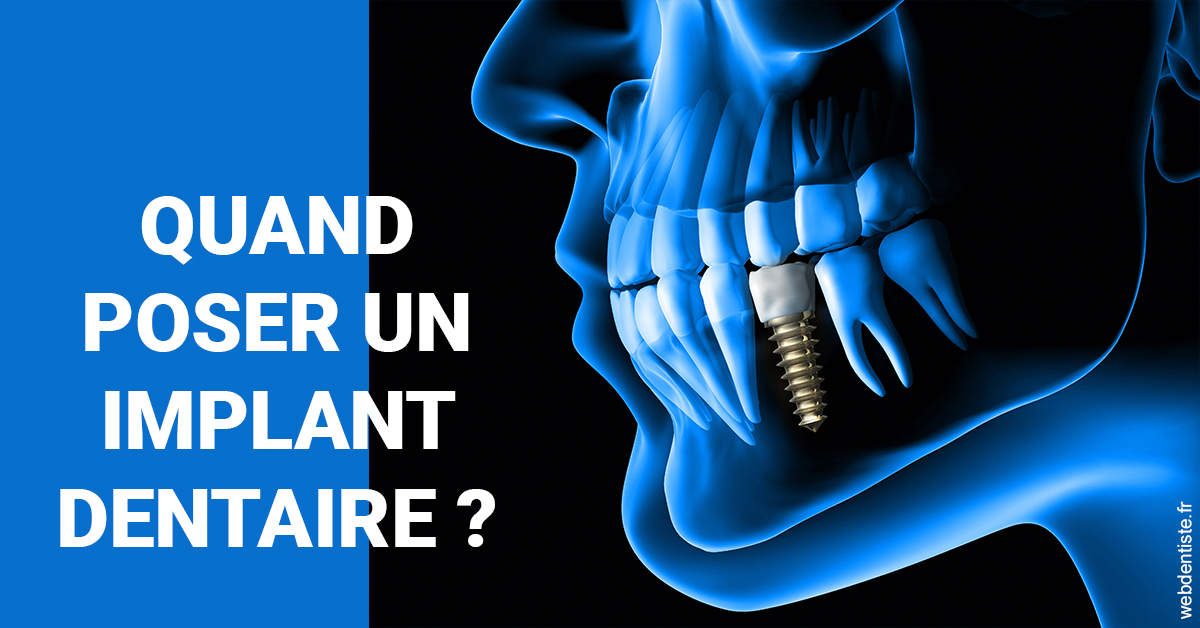 https://dr-abbou-michel.chirurgiens-dentistes.fr/Les implants 1