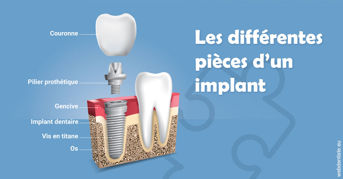 https://dr-abbou-michel.chirurgiens-dentistes.fr/Les différentes pièces d’un implant 1