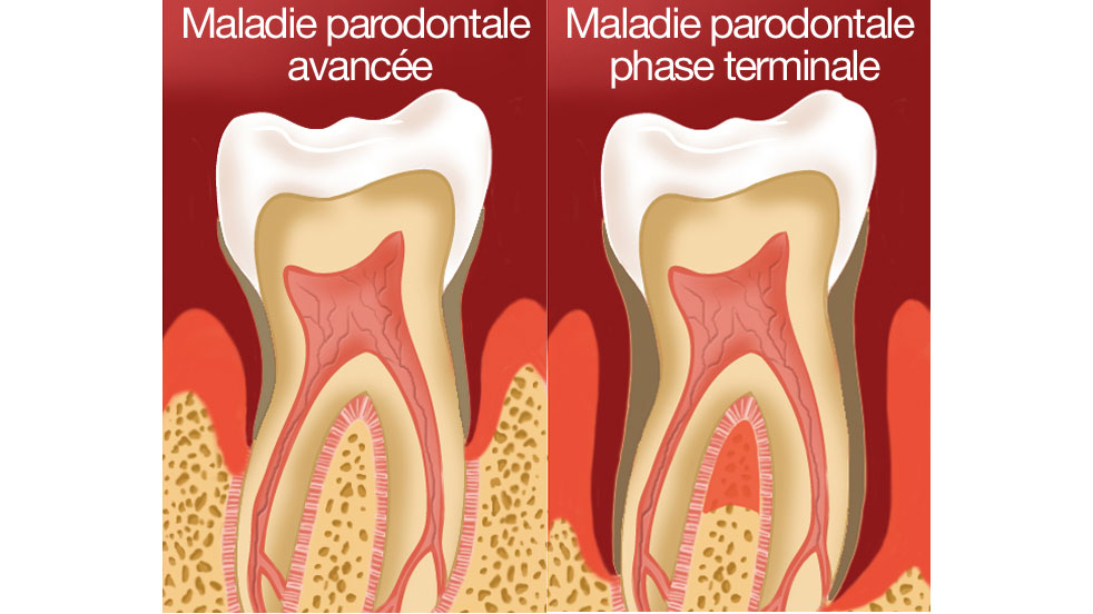 Maladie parodontale