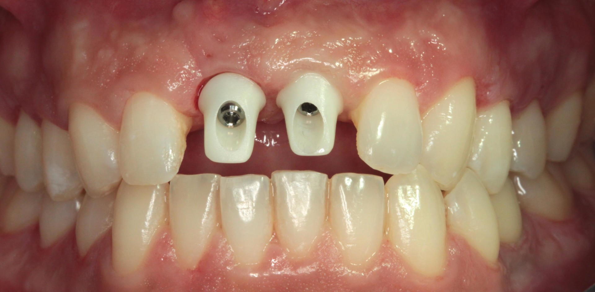Etape intermédiaire  implants antérieurs et blanchiment des dents
